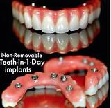 How Can Clear Choice Do Implants In One Day Photos