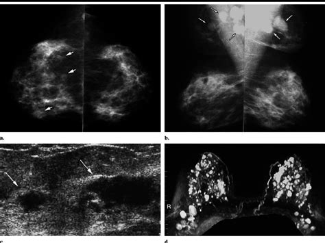 Images In 57 Year Old Woman With Bilateral Diffuse Foci Of Ilc Patient