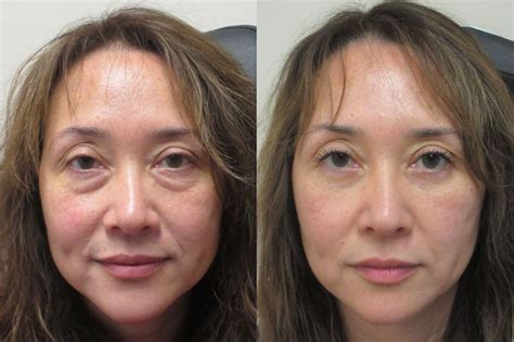 Remove Under Eye Bags Without Surgery
