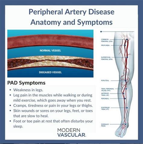 Pin On Peripheral Artery Disease