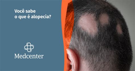 Voc Sabe O Que Alopecia Blog Medcenter