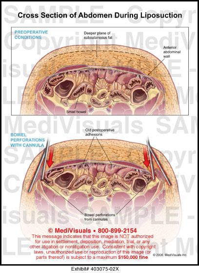 Cross Section Of Abdomen During Liposuction Medical Exhibit