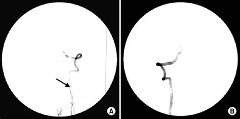 Cerebral Angiography Of Patient 1 Cerebral 4 Vessel Angiography Shows