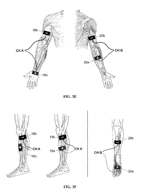 Patent Us20090326607 Electrical Stimulation Method For Treatment Of