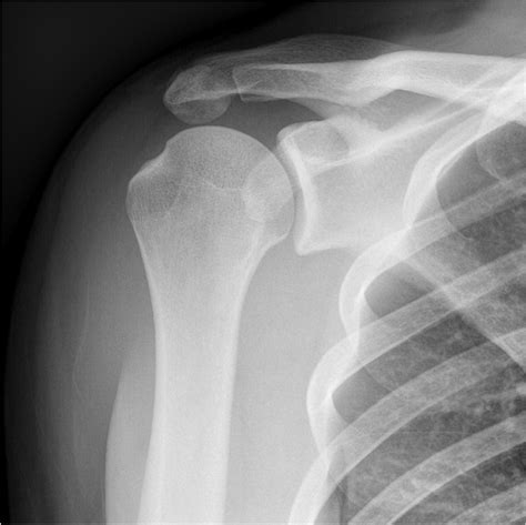 Os acromiale with impingement | Image | Radiopaedia.org