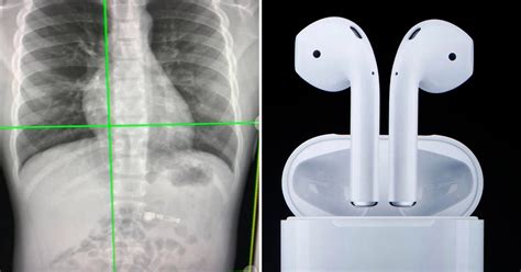 Man Swallows Airpod Gets It Removed Edm Honey