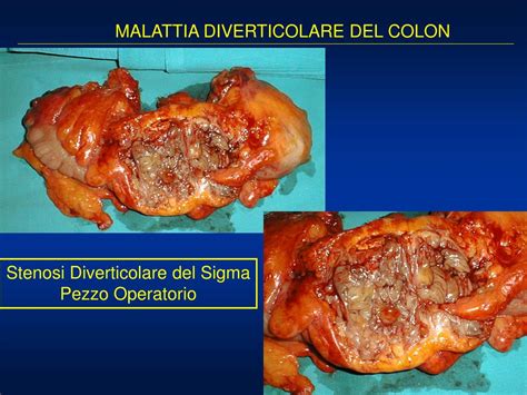 Nella stenosi carotidea bilaterale o stenosi di un lato con ostruzione controlaterale, quale va operata delle due arterie o se. PPT - MALATTIA DIVERTICOLARE DEL COLON PowerPoint ...