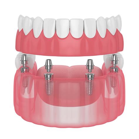 Por Qu Elegir Sobredentadura Sobre Implantes Grupo Dental Cibeles