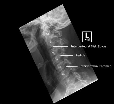 Cervical Spine Radiographic Anatomy Medical Radiography Radiology