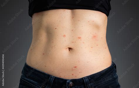 Foto Stock Heat Rash On Stomach Of Woman Fit Female Torso With Prickly Heat Or Miliaria From