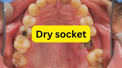What Is Dry Socket Youtube