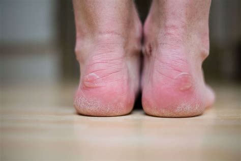 Foot Blisters Foot Specialist Toronto Feet First Clinic