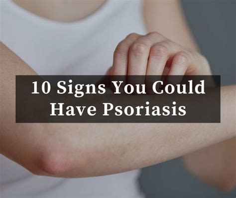 10 Signs You Could Have Psoriasis Healthy Habits