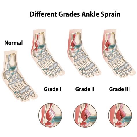 Check spelling or type a new query. The Three Degrees (types) of Ankle Sprains