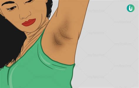 Dark Underarms Causes Home Remedies Creams Medical Treatment And Tips