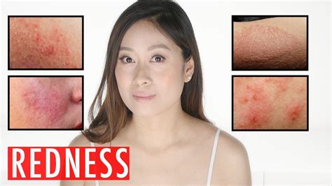 Redness On Face Causes Products To Get Rid Of Red Skin Youtube