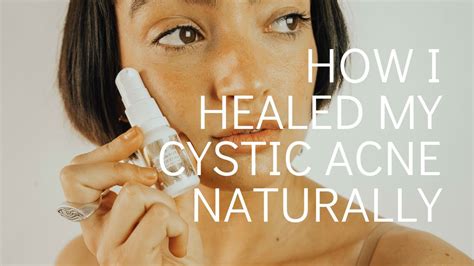 How I Healed My Cystic Hormonal Adult Acne Naturally Youtube