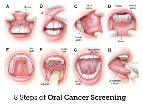 how to do an oral cancer screening cancerwalls