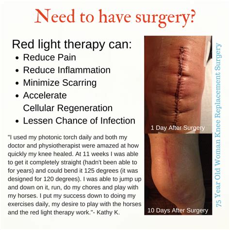 Red Light Therapy Applied To 10 Day Old Knee Replacement Surgical Scar
