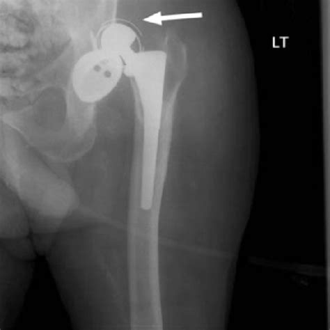 Right Total Hip Replacement With Loosening Of The Acetabular Component