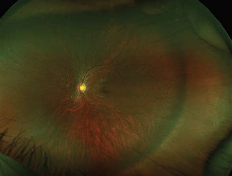 The Role Of Scleral Buckling In 2021 Retina Today