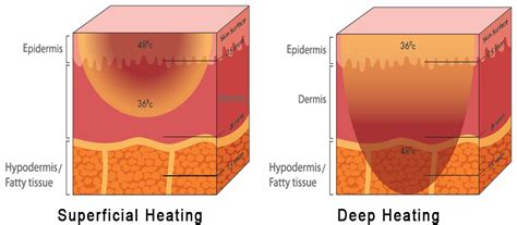Superficial Heating Deep Heating Clear Sky Medical