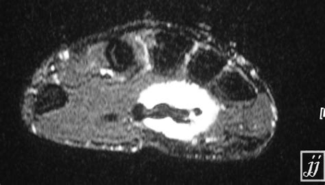 Ganglion Cyst Around Flexor Tendon Hand T2 Radiopaedia