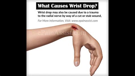 Wrist Drop Saturday Night Palsy Resulting From Damage To Radial