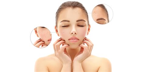 Nodular Acne Causes Treatments Options And Prevention Tips