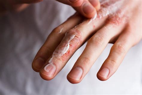 How To Guard Against Dry Chapped Hands During A Covid 19 Pandemic