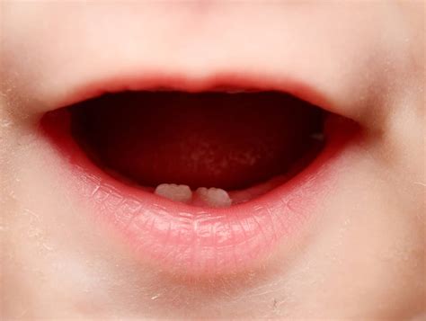 How Long Does Teething Last Kid Care Pediatrics