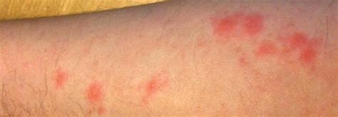 What Do Bed Bug Bites Look Like Rashes Symptoms And Treatment