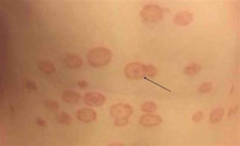 Tinea Versicolor Common Skin Disease Health Blog