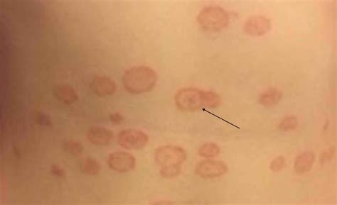 Tinea Versicolor Common Skin Disease Apps Treatment