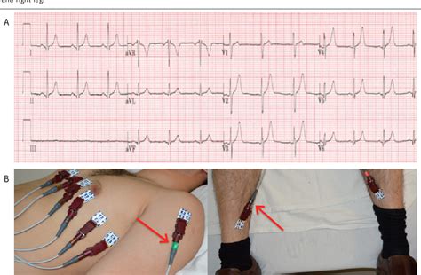 Figure 7 From Common Ecg Lead Placement Errors Part I