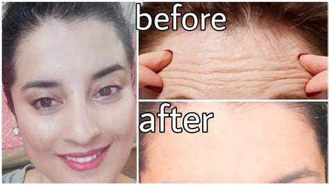 Face Massage For Forehead Wrinkles Tips Skincare Face Exercises Treatment Rachna Jintaa Youtube