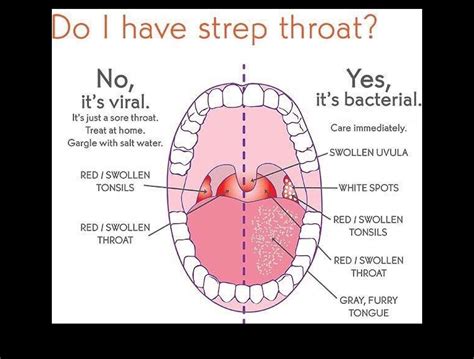 Pinterest Swollen Uvula Swollen Tonsils Strep Throat