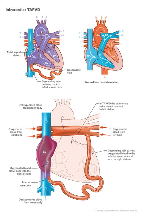 In a child born with total anomalous pulmonary venous return (tapvr), the pulmonary veins connect to other veins, and ultimately drain their blood into the right atrium. Cardiology : Total Anomalous Pulmonary Venous Drainage TAPVD