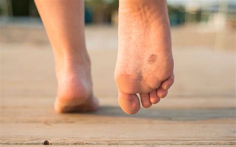Signs Its Time To Treat Foot Skin Cancer