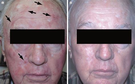 A Trial Of Short Incubation Broad Area Photodynamic Therapy For Facial