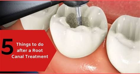 Swelling after root canal treatment. 5 Things to do after a Root Canal Treatment - Expert ...