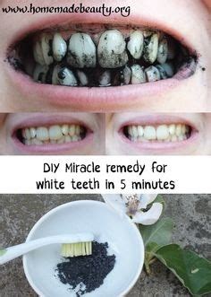 How long to wear custom teeth whitening trays. kalem teeth: How to get white teeth overnight