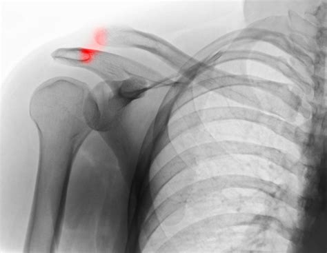 Separated Shoulder Or An Injury To The Ac Joint