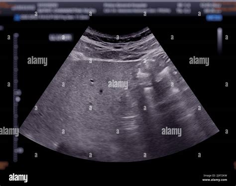 Échographie Du Haut De Labdomen Montrant Le Foie Photo Stock Alamy