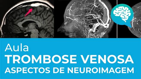 Trombose Venosa Aspectos De Neuroimagem Aula Dr Bebeto Moreira De