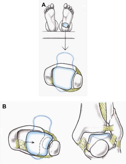 References In Corrective Osteotomies For Malunited Malleolar Fractures
