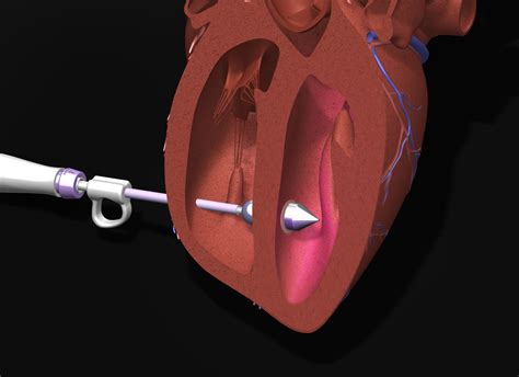 Light Reflecting Balloon Catheter For Heart Repair