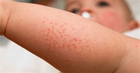 Red Bumps On Babys Face And Legs 7 Reasons To Check