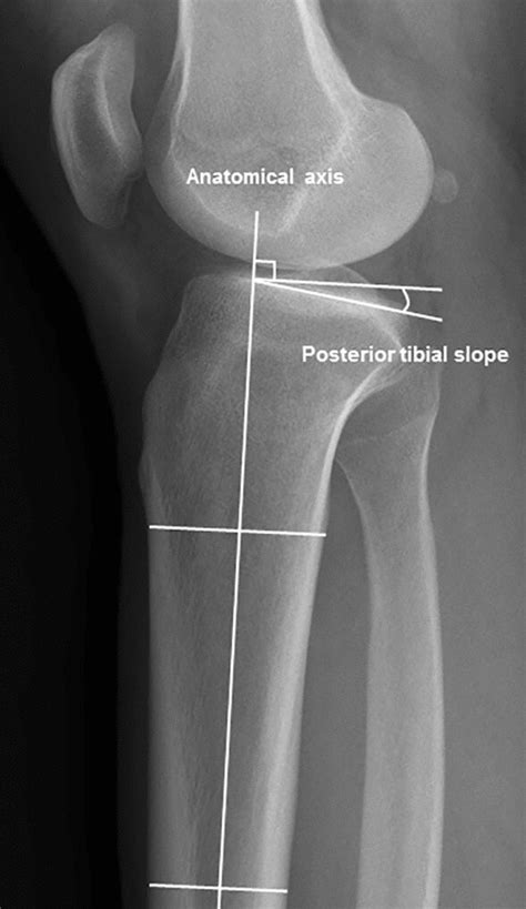 For The Measurement Of The Posterior Tibial Slope The Anatomical Axis