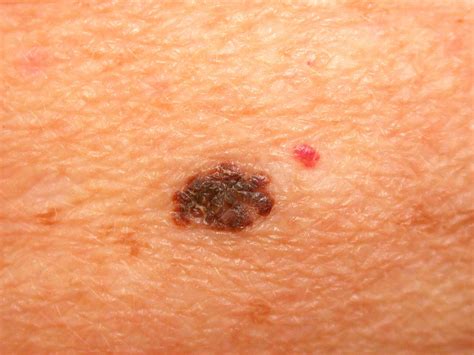 Your Guide To Stage 0 1 And 2 Melanoma Treatment 2023